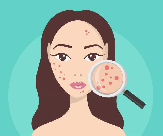 take part in trials for acne treatments
